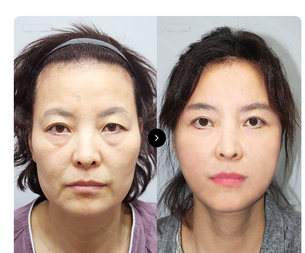 SMAS 안면거상 BEFORE & AFTER — 수술 전후 비교