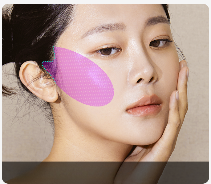 귀 앞 절개라인과 중안면부 리프팅 범위를 보여주는 얼굴 클로즈업