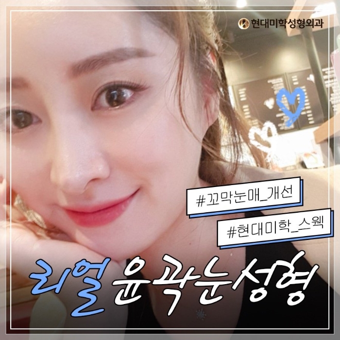 뒤트임성형외과 성공적인 완성