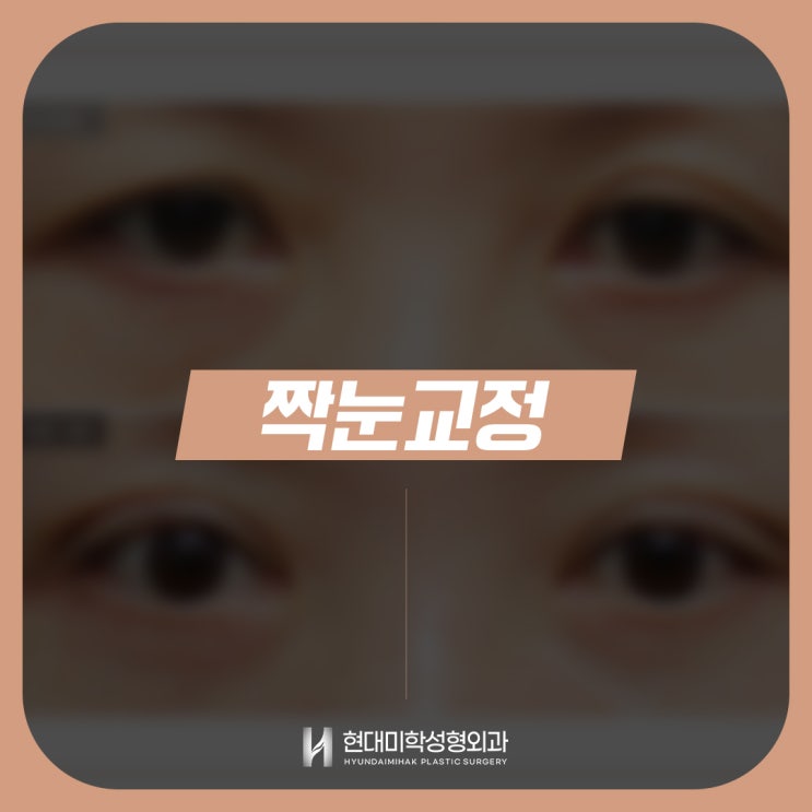 짝눈교정가격과 함께 알아야할 중요 사항들
