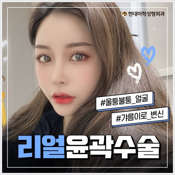 윤곽성형 잘 알아보고 해요