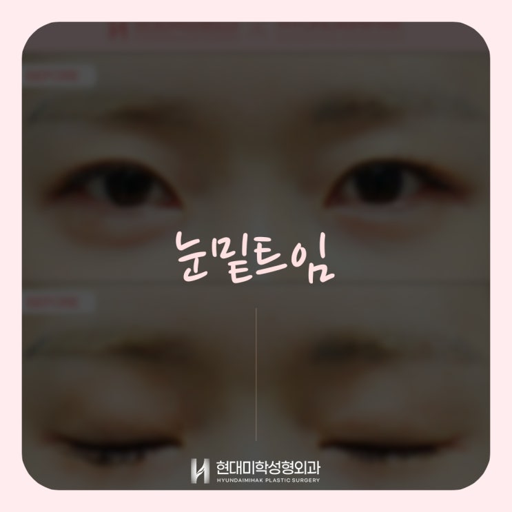 눈밑트임잘하는곳, 자연스러운 눈매변화는 현대미학성형외과에서