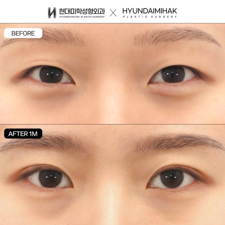 쌍수잘하는병원 예쁜 눈매를 만드는