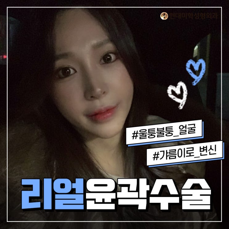 안면윤곽유명한곳 라인이 예술이야