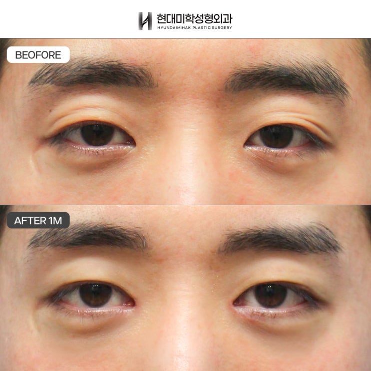 남자눈매교정후기 확연한 전후 변화를 원한다면
