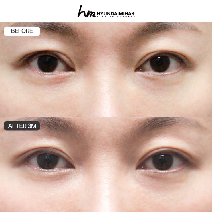 눈매교정재수술 현대미학성형외과의 안전 가이드