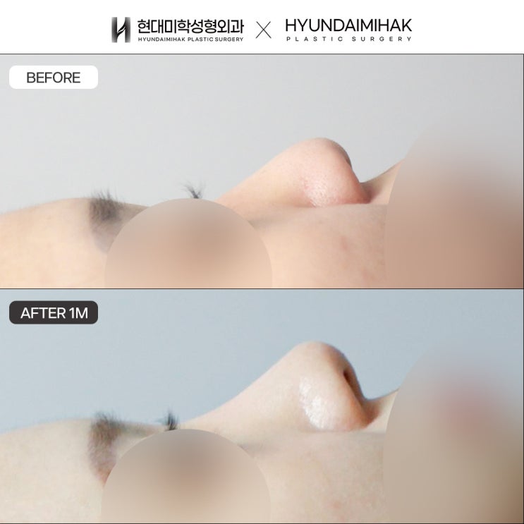 코성형잘하는곳 중요 고려사항