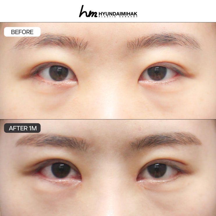 눈재수술성형외과 실패 막는 핵심 포인트