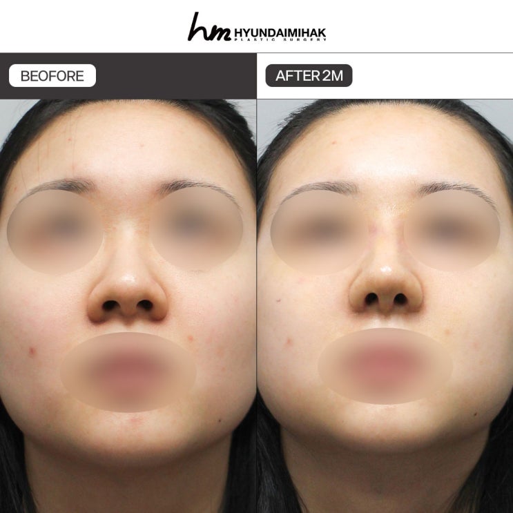 복코수술 전후, 자연스럽고 세련된 인상으로 변화하는 비밀｜현대미학성형외과 복코 교정 노하우