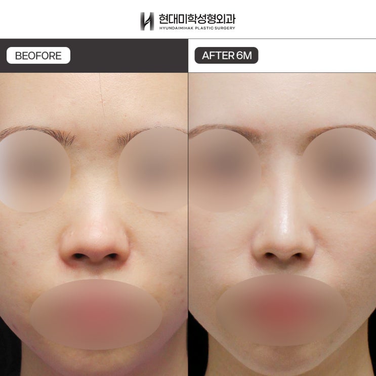 낮은코성형비용 재료부터 항목에 따라서
