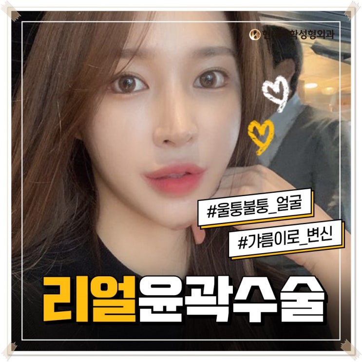 긴턱축소 황비를 찾았다