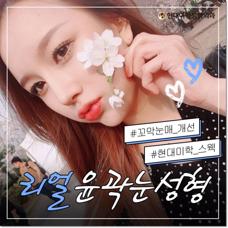 눈밑트임후기 현대미학이 짜세지