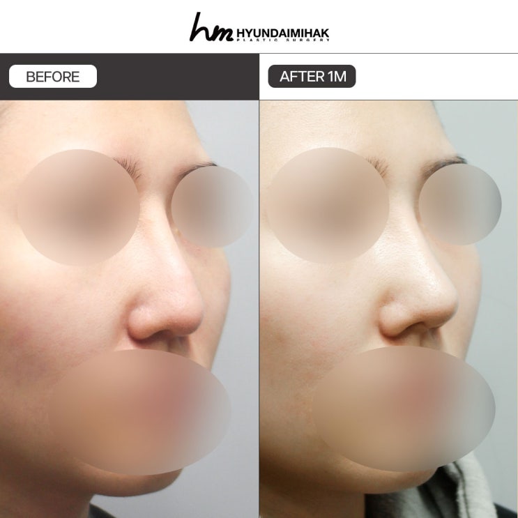 비순각수술 균형있는 얼굴 개선의 열쇠