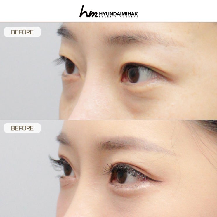강남쌍꺼풀재수술 첫눈에 반하는 자연라인