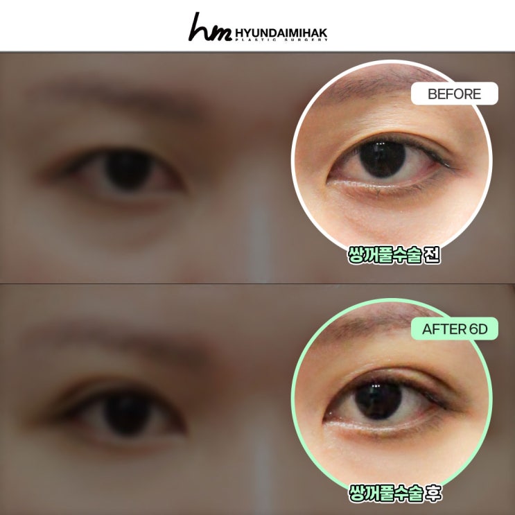 강남눈성형외과 첫 수술부터 재수술까지 선택 가이드