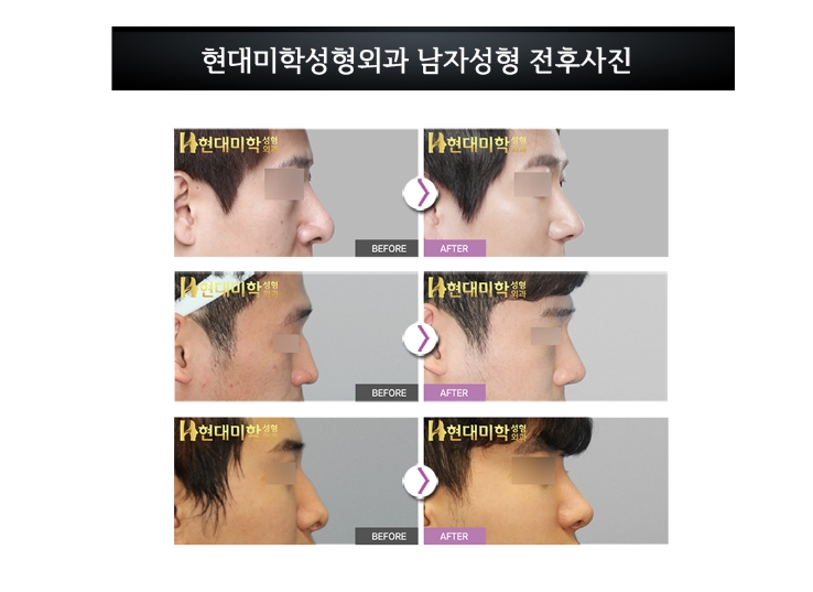 "남자코성형비용" 궁금한데 어떻게?!