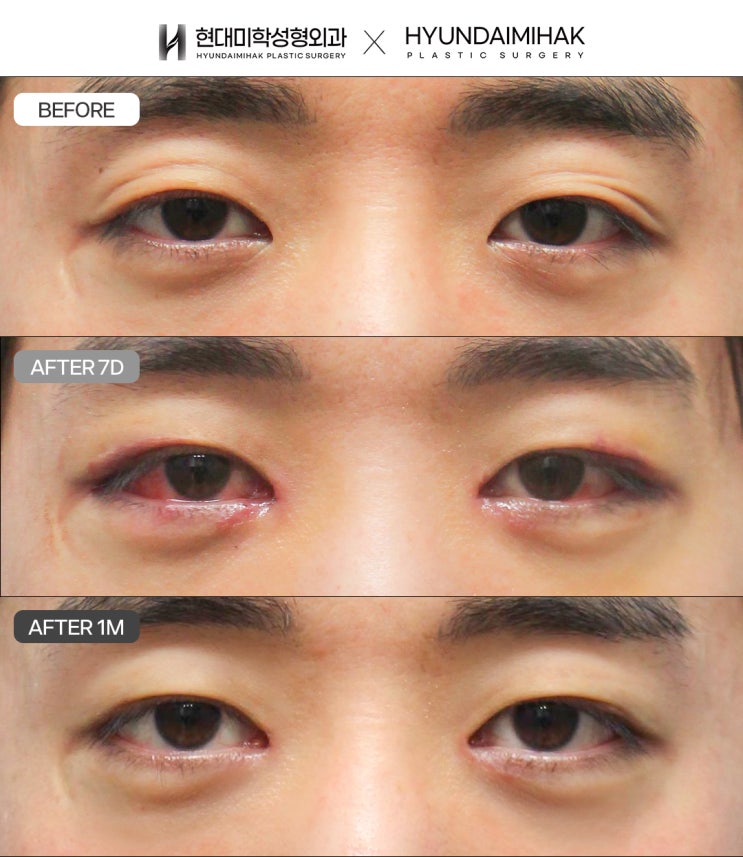 남자무쌍눈매교정 졸린 인상의 변화