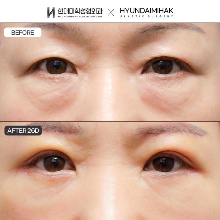 상안검수술가격 나이 들어 처진 눈매