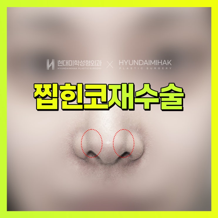 찝힌코재수술, 어떤 방식으로 진행해야 할까?