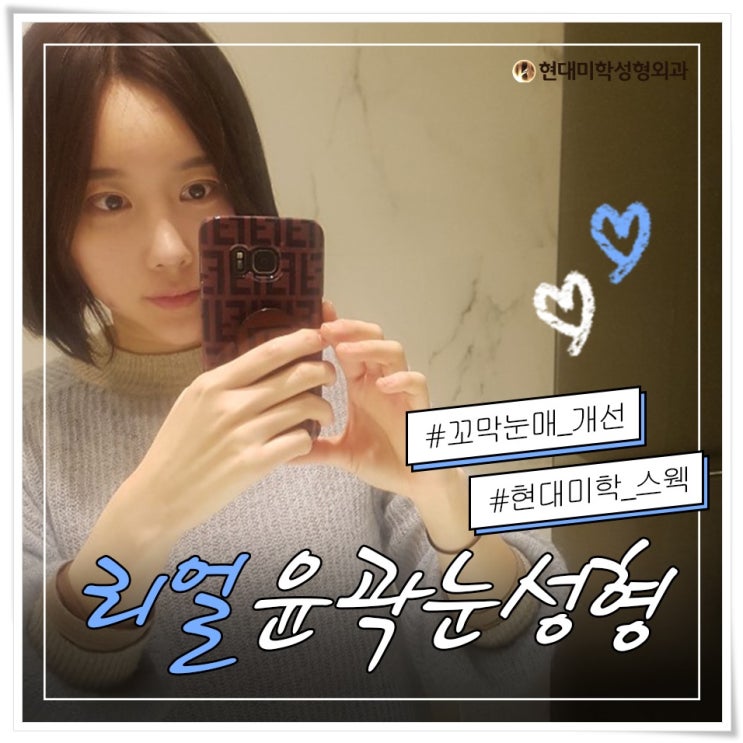 소세지쌍꺼풀 원인해결하기