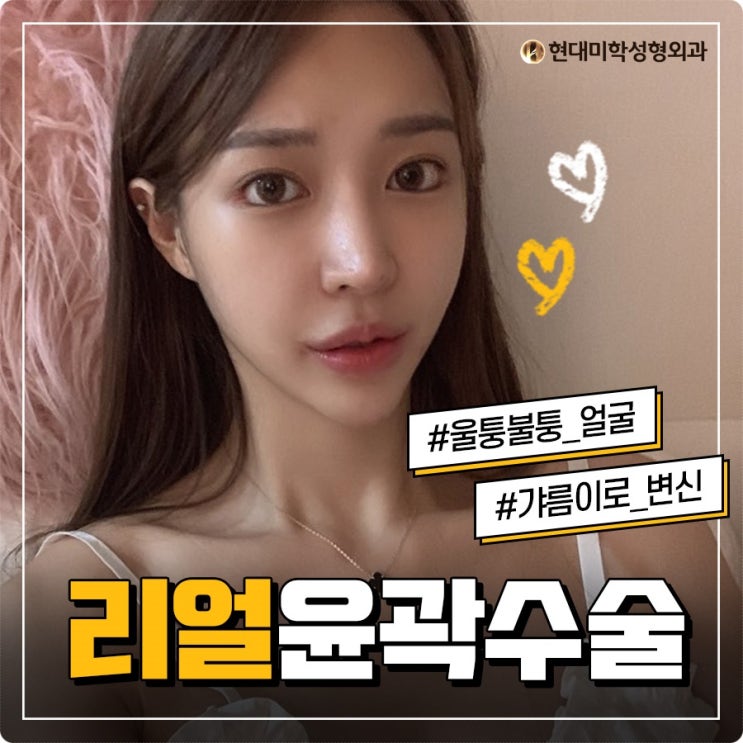 안면윤곽성형비용 중요한건무엇?