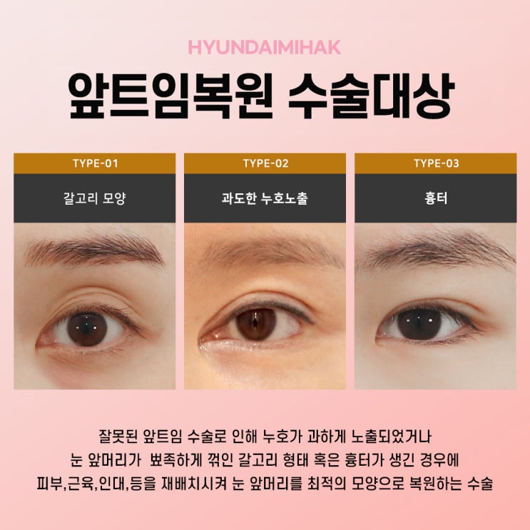 앞트임재건으로 자연스럽게 눈매회복하기