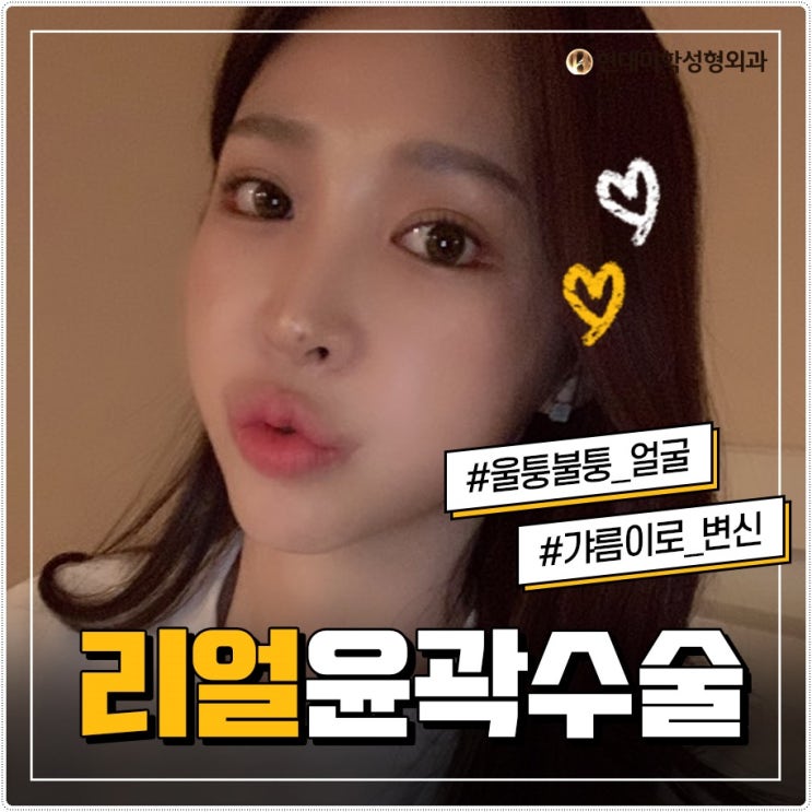 턱끝수술비용 보다 아름답게