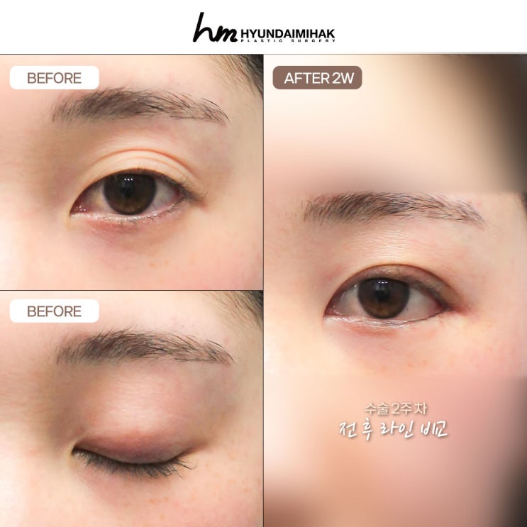 쌍꺼풀자연유착 현대미학에서 절개 없이 예뻐지자