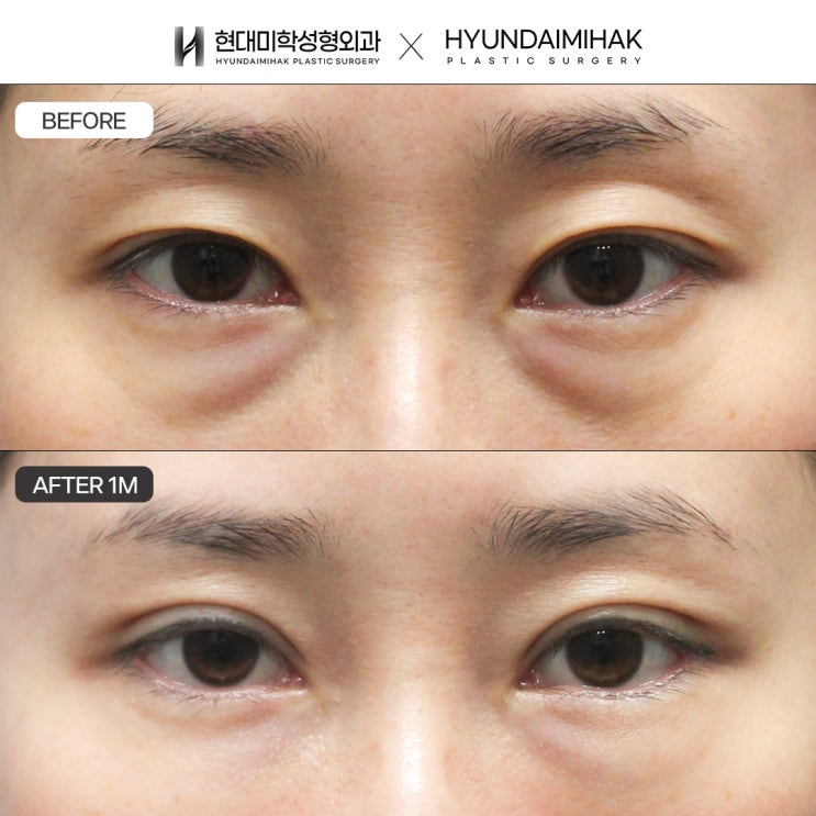 상안검잘하는곳에서 눈꺼풀처짐 해결하고 시야개선까지