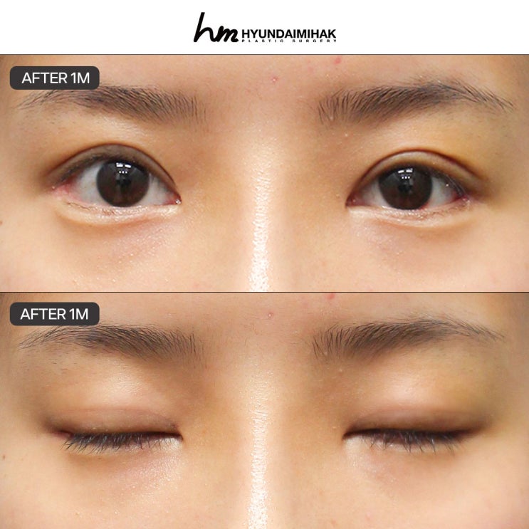서울쌍꺼풀수술 인상 변화의 시작