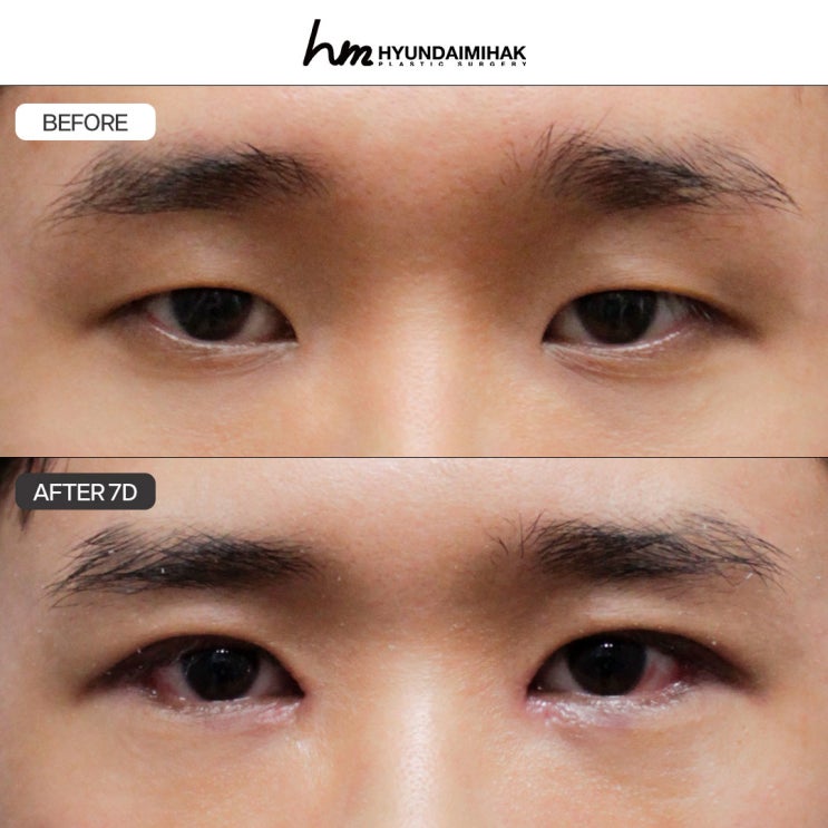 남자눈성형외과 자연스러움이 핵심입니다