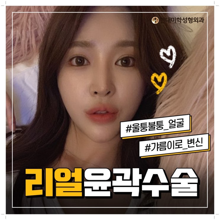 광대수술방법 연예인뺨치네