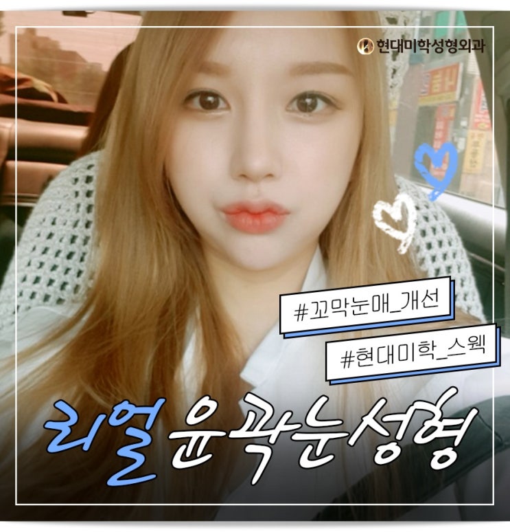 눈절개재수술 자연스러운 결과
