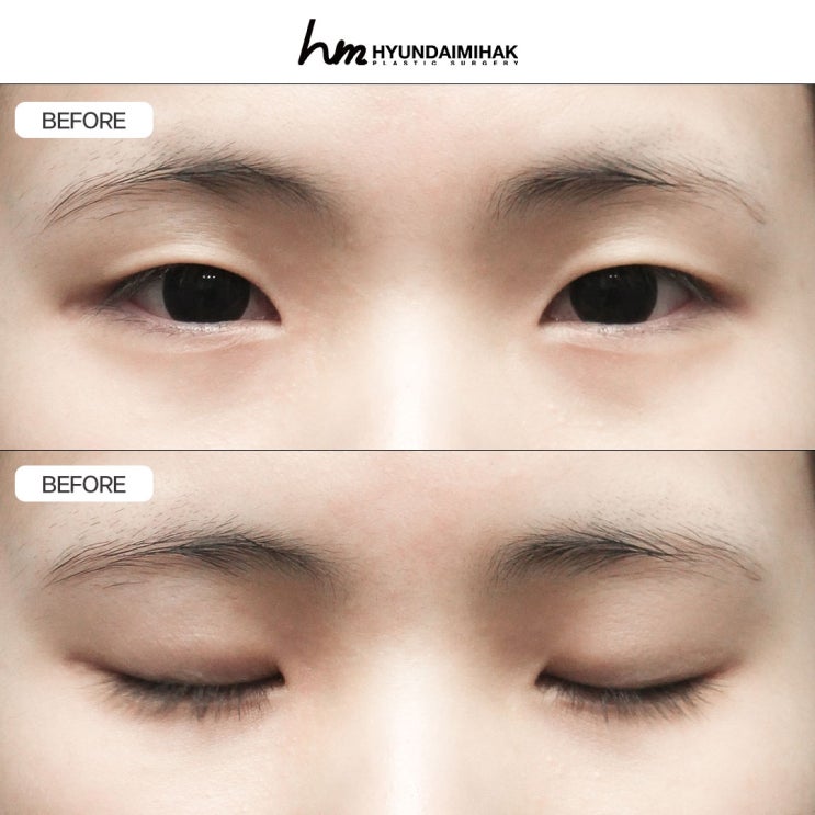 절개쌍꺼풀수술 눈매의 본질을 바꾸는 디자인 성형｜수술법·만족도·회복방법까지 완벽정리