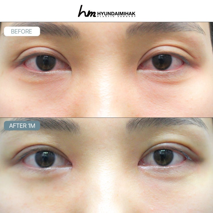눈재수술후기 모음 현대미학성형외과가 알려주는 성공포인트