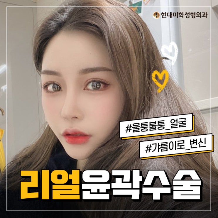 광대성형 갸름 라인을 원해?
