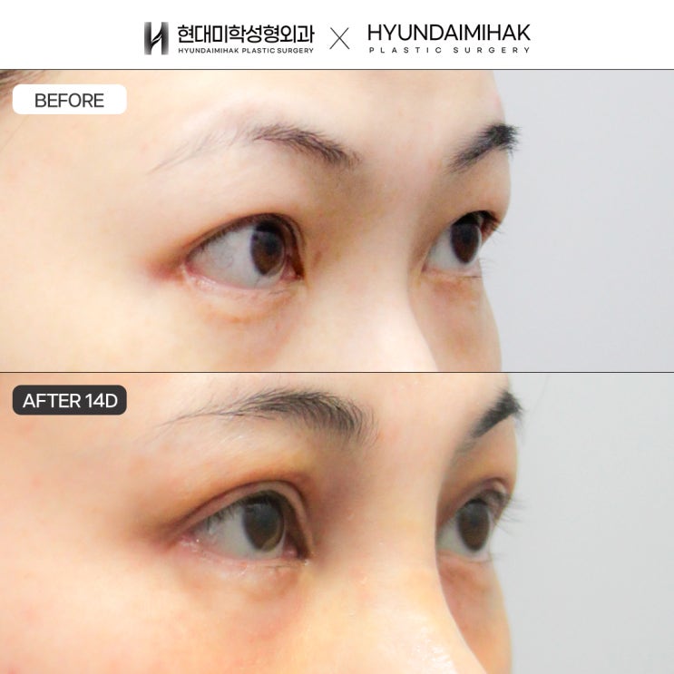 뒷트임복원잘하는곳 재건 원인과 대상