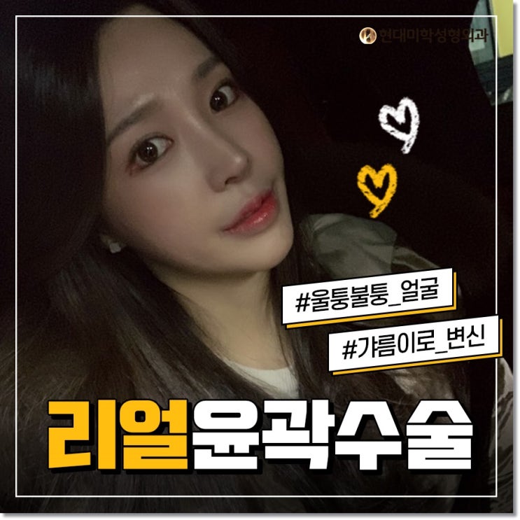 얼굴축소수술 라인의 완성은?