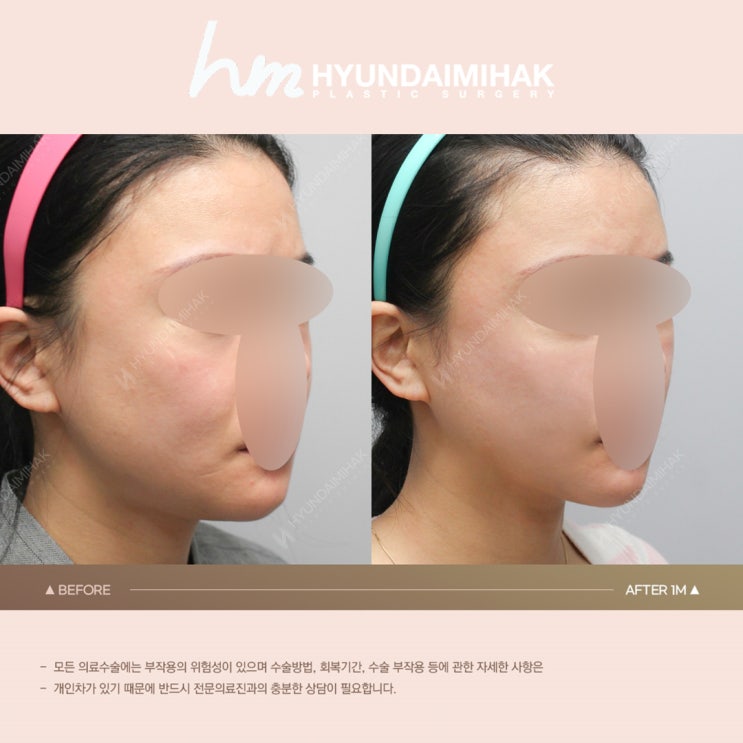 윤곽주사추천 얼굴살 정리하고 V라인 찾고 싶다면
