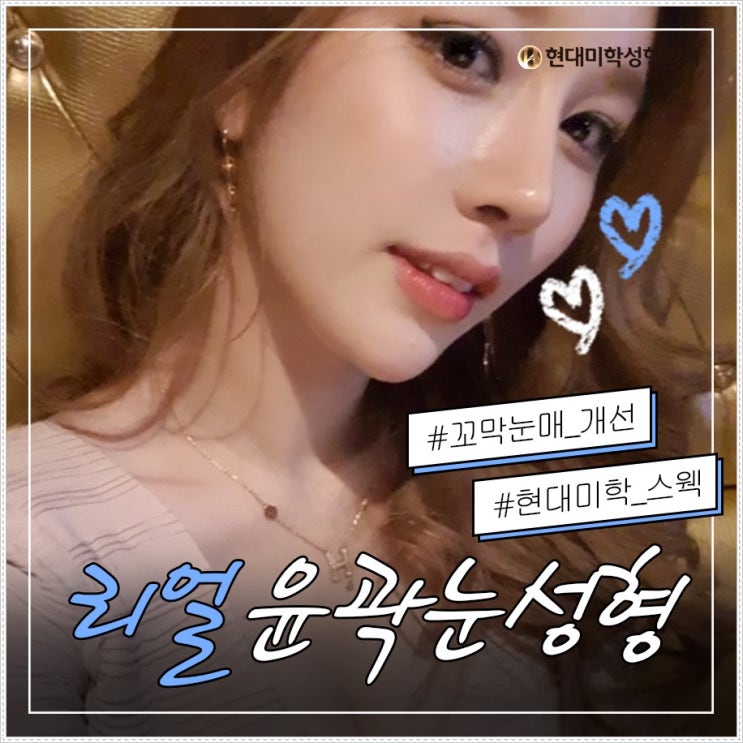 비절개눈매교정수술 이건몰랐지?