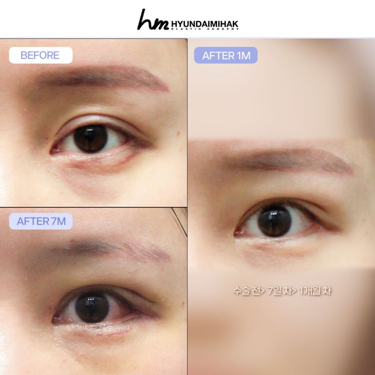 트임성형 눈매의 조화와 인상을 바꾸는 선택