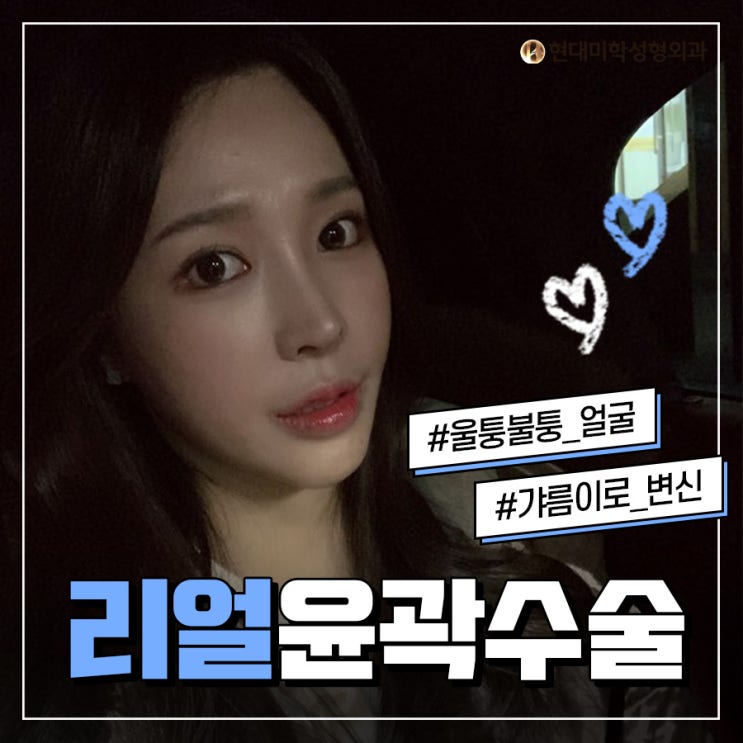 광대축소술후기 갸름라인 완성