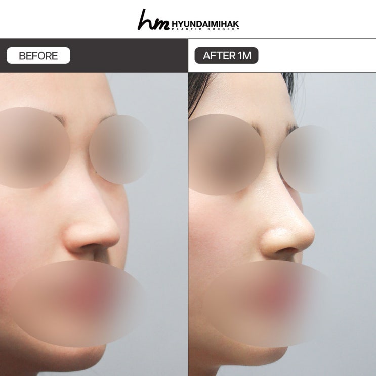 매부리코수술가격 싸다고 좋은 건 아닙니다