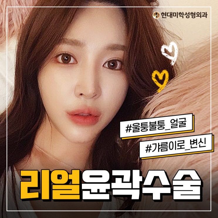 사각턱성형 아름다운 라인을 완성해요