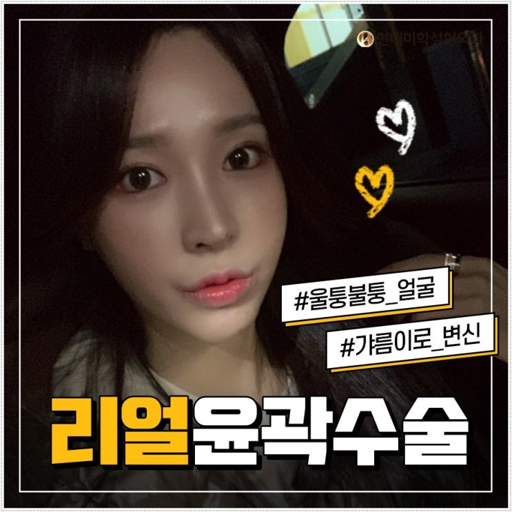 T절골 맞춤의 V라인을