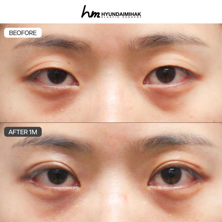 눈매교정성형외과 자연스럽고 또렷한 눈매로의 변화