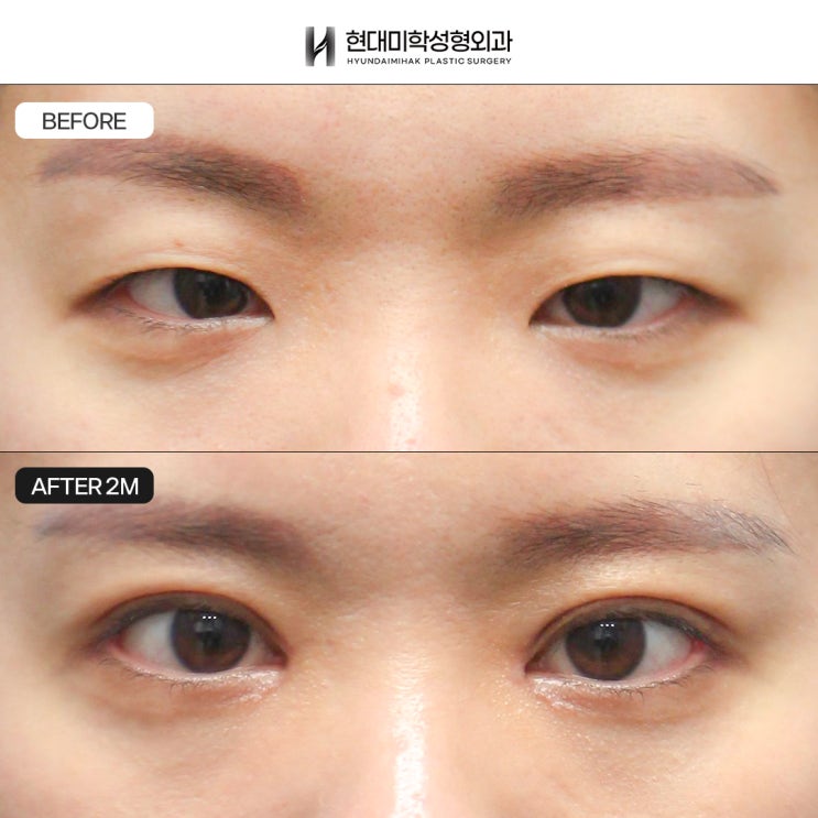 절개쌍꺼풀후기 눈매를 같이 교정하면서
