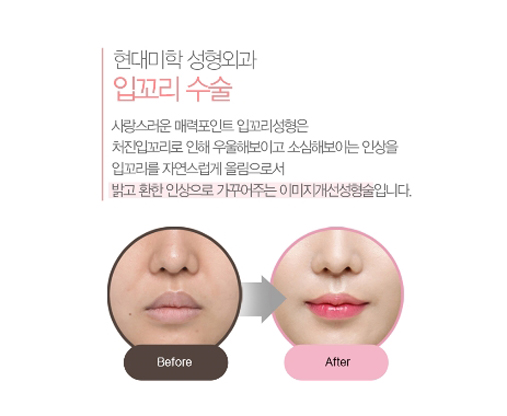 입매성형후기 숨어있던 밝은 미소를 찾아