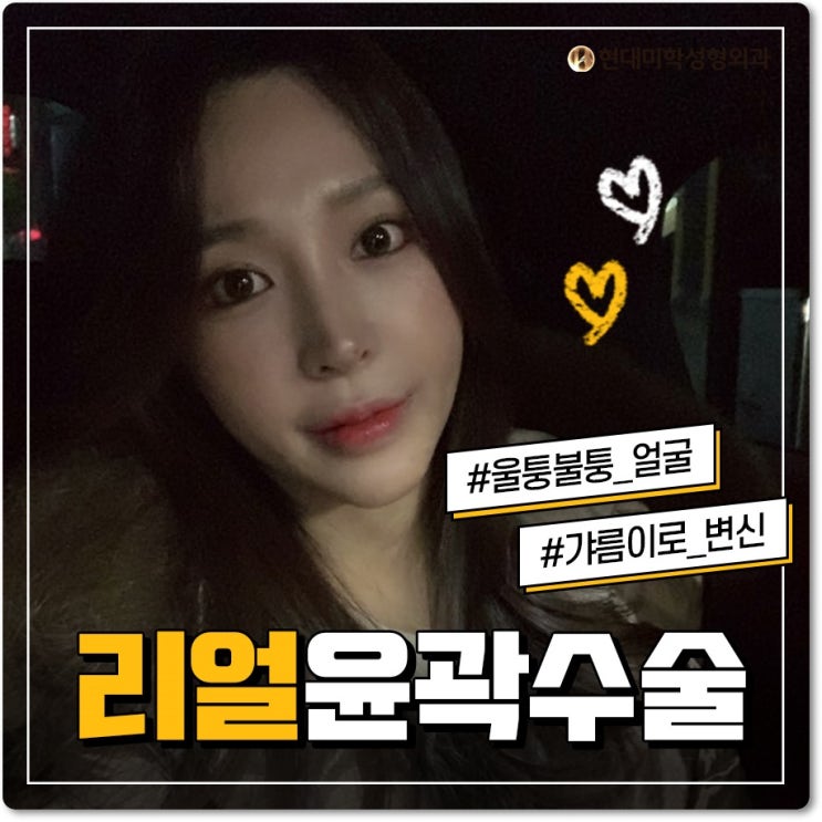 윤곽수술 라인의 완성