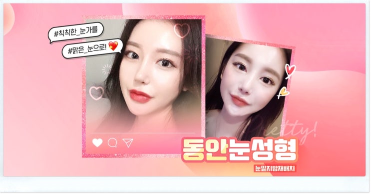눈밑지방재배치잘하는병원 어떻게 선택하는게 좋을까요.